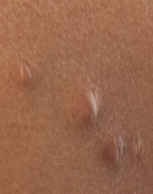 Acne Scars