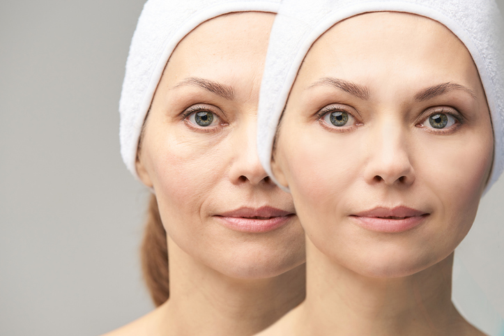 Is Juvederm the Wrinkle Solution You've Been Looking For?
