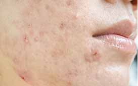 acne scarring