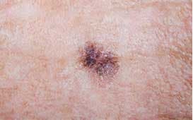 moles_&_skin_cancer