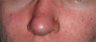 acne patient after