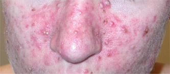 acne patient before