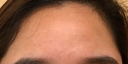 Acne patient after