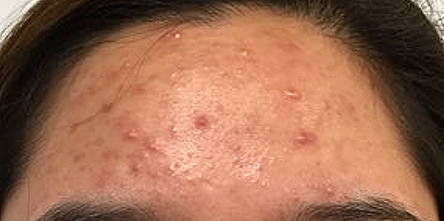 Acne patient before