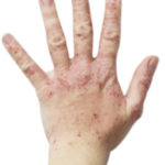 Eczema on a female hand