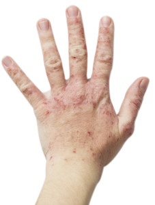 Eczema on a female hand