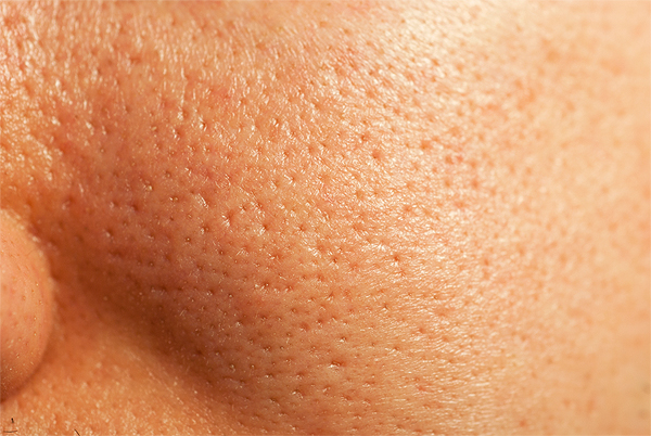 Microneedling