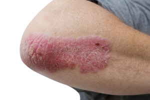 Psoriasis