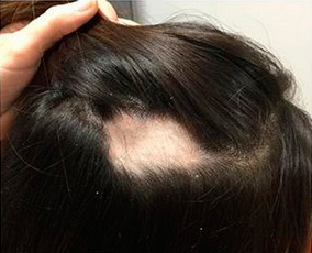 alopecia first treatment