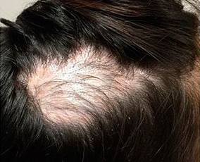 alopecia third treatment