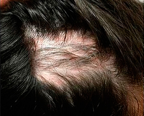 alopecia fourth treatment