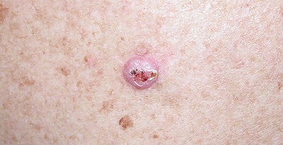 basal cell carcinoma example