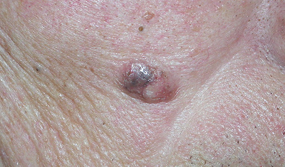 basal cell carcinoma example