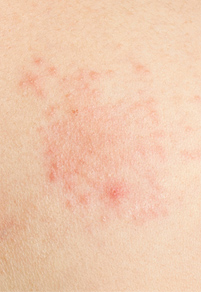 eczema treatment