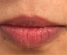 Juvederm Ultra before treatment