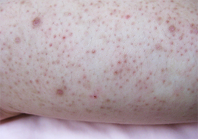 keratosis pilaris example