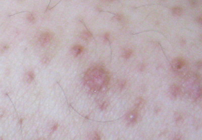 keratosis pilaris example