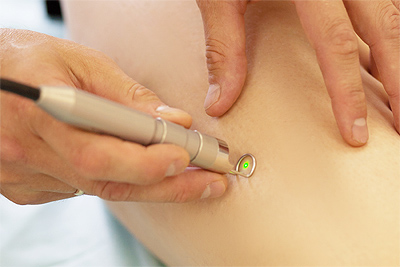 laser use example