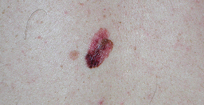 melanoma example