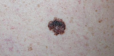 melanoma example