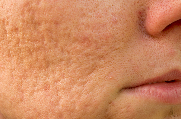 microneedling acnescars