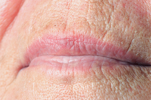 microneedling lip wrinkles