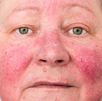 Rosacea example