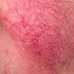 rosacea