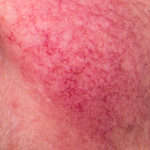 rosacea