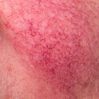 What is Rosacea?