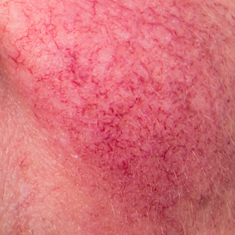 Rosacea example