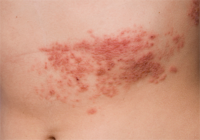 Shingles example