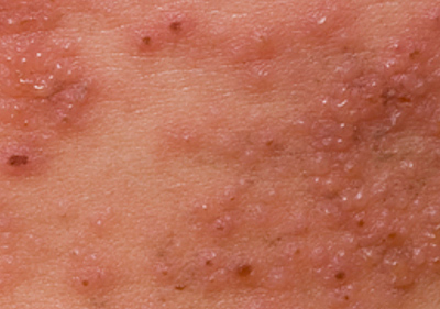 Shingles example