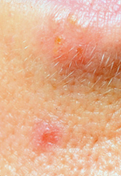 acne example