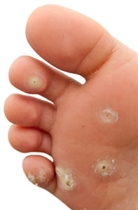 foot warts