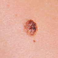 Melanoma