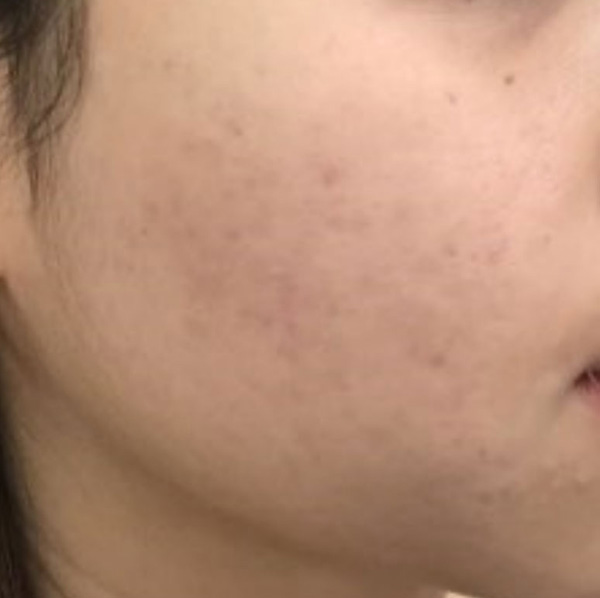 acne cheek after