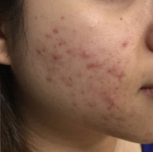 acne cheek before