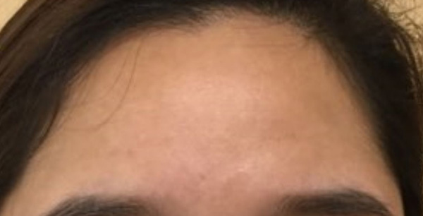 acne forhead after