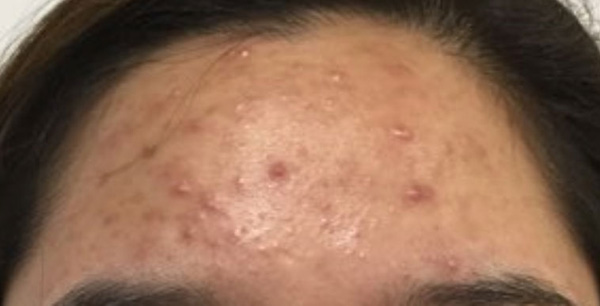 acne forhead before