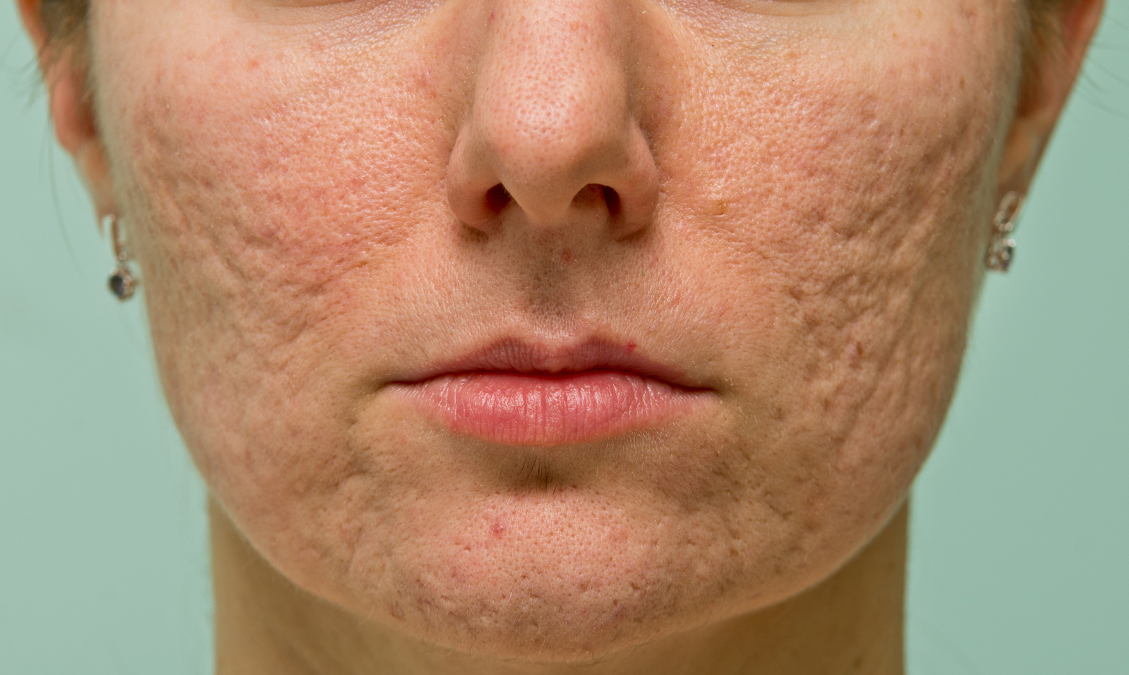 Acne Scarring