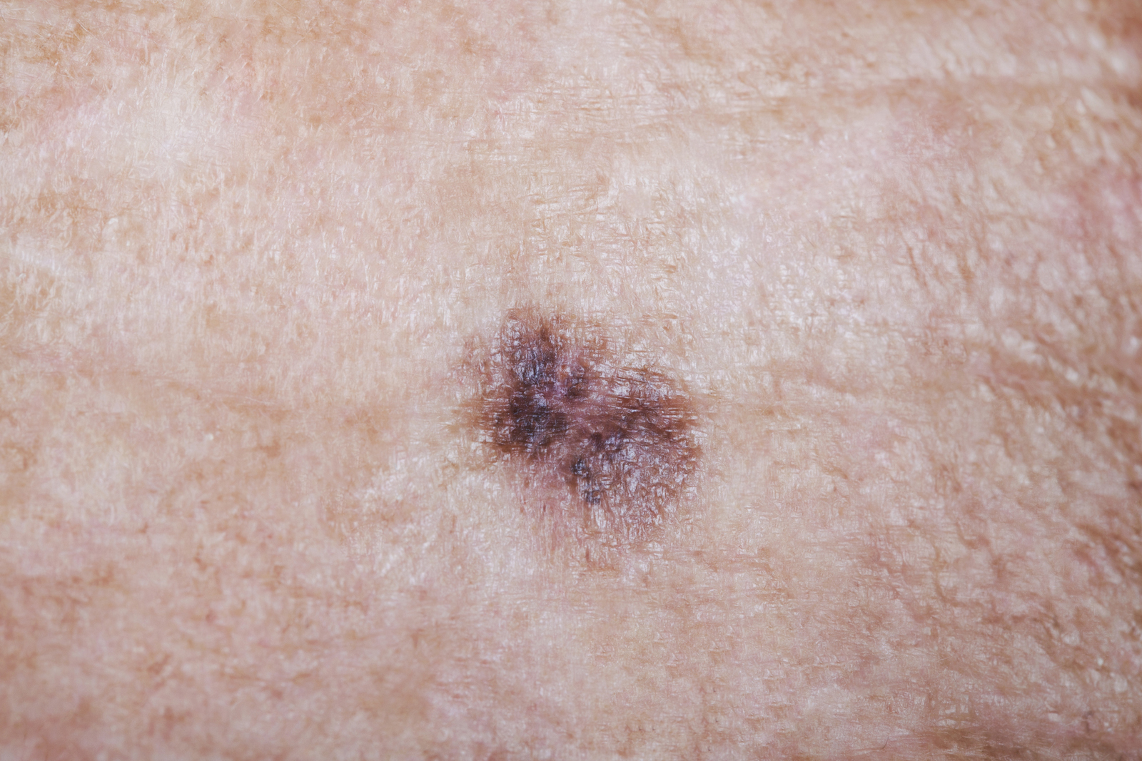 Lentigo Maligna Melanoma