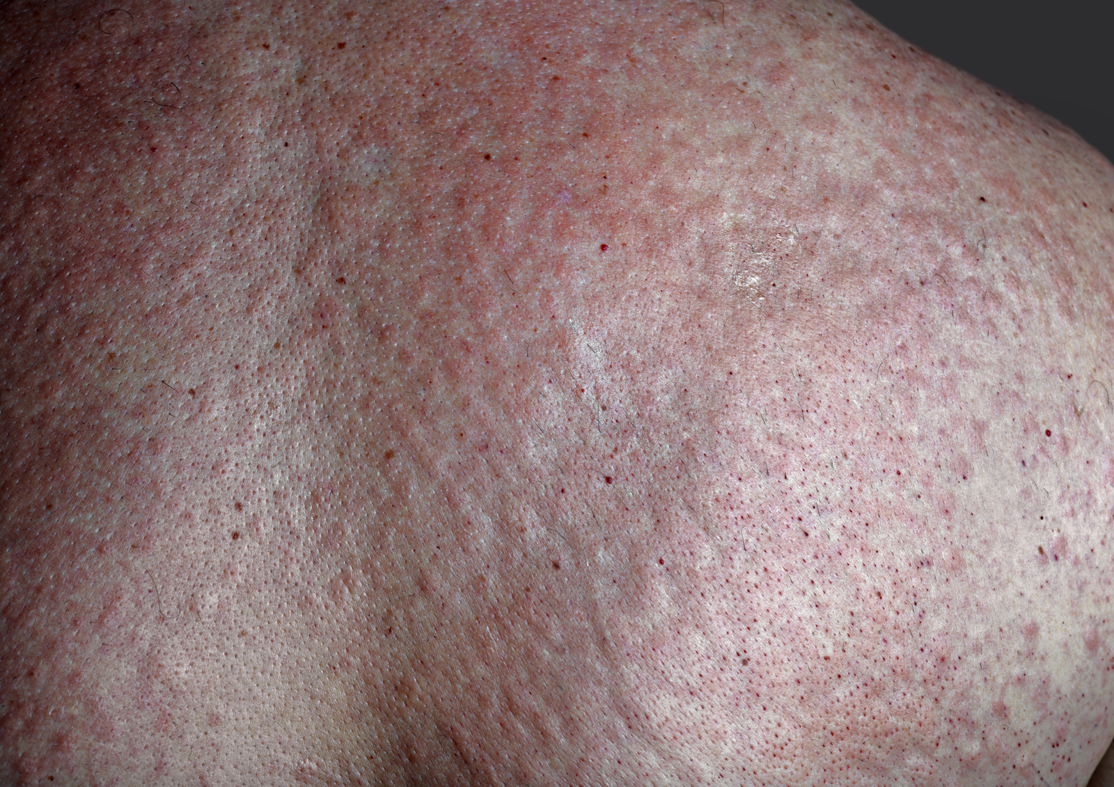 Rash on the back of a male after waxing