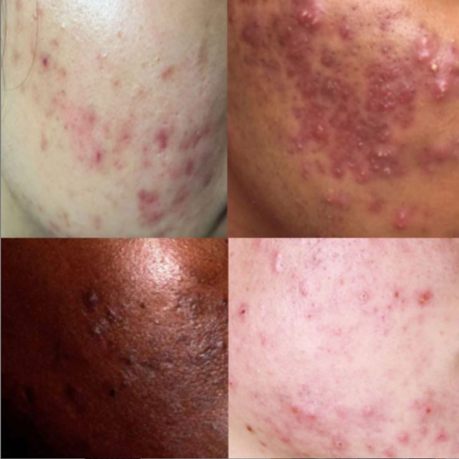 Examples of acne