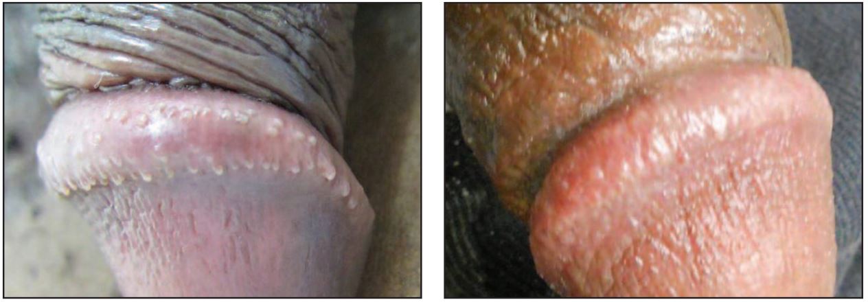 Pearly Penile Papules are tiny bumps on the tip of the penis