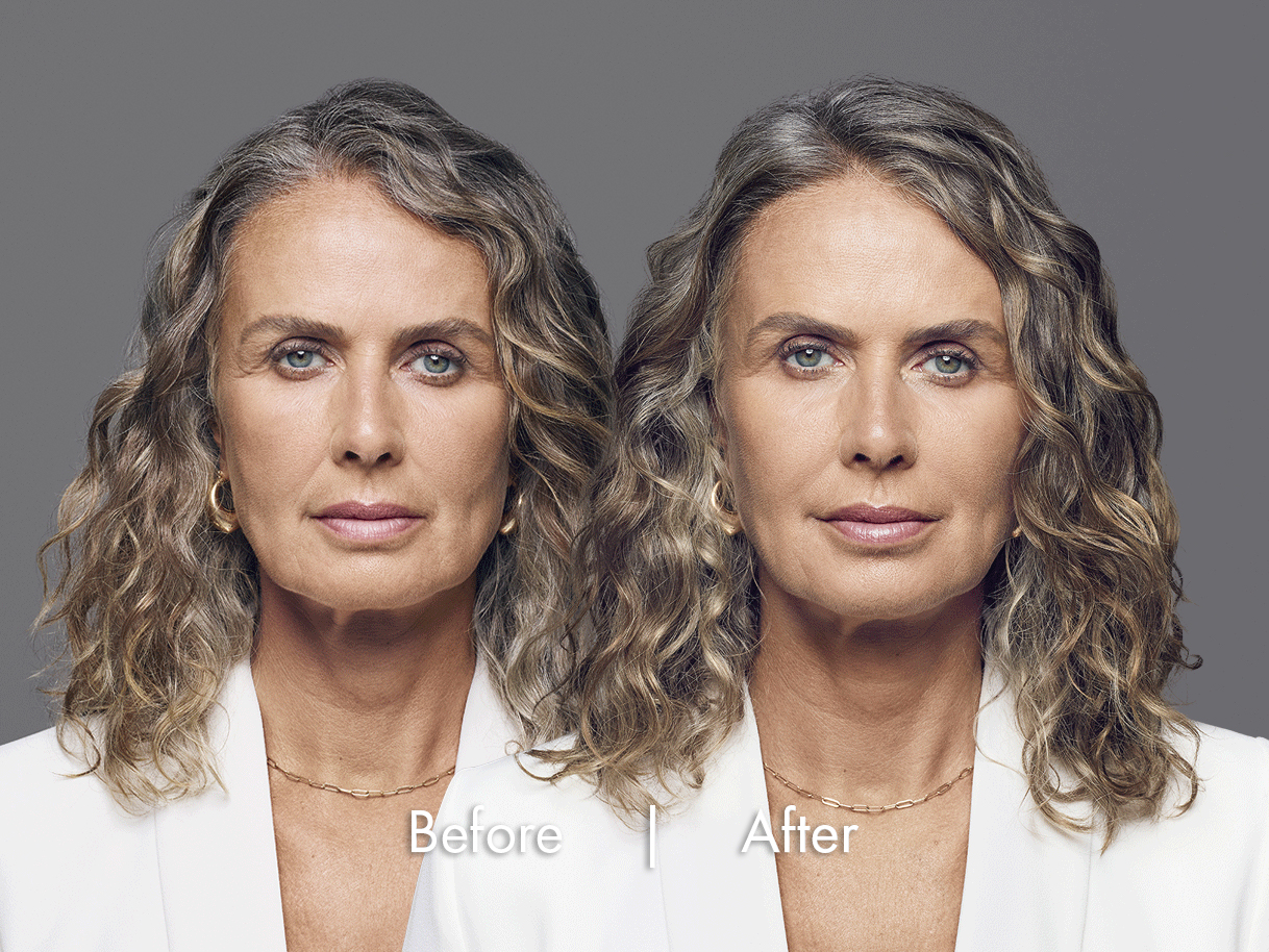 RHA dermal fillers before and after results