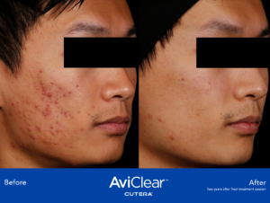 aviclear before and after picture acne treatment