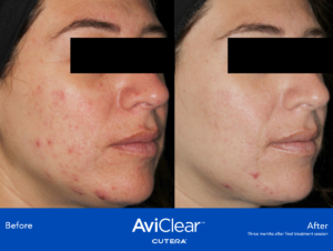 acne laser treatment results