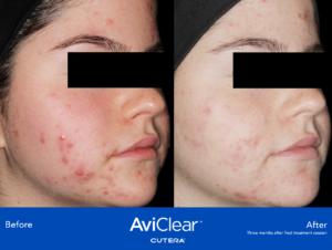 acne laser results following 3 treatments