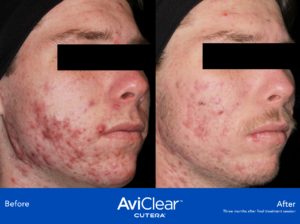 aviclear before and after acne laser treatment